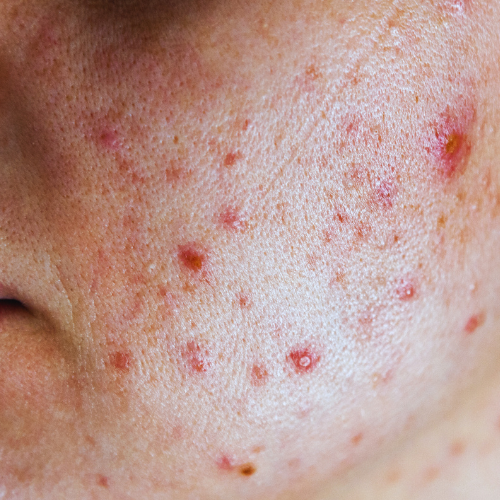 Acne Control